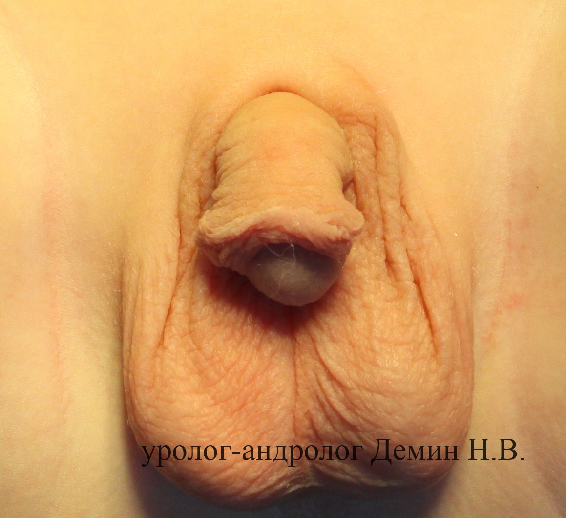 Стволовая гипоспадия, фото после операции