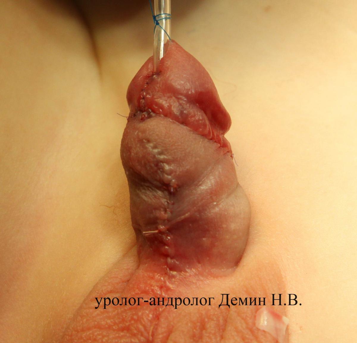 Стволо-мошоночная гипоспадия, фото после операции